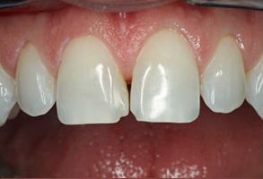 Dental Artistry of Livingston | Dental Bridges, Night Guards and Dentures